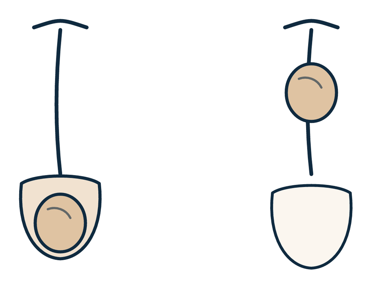 İnmemiş Testis (Çocuklarda)